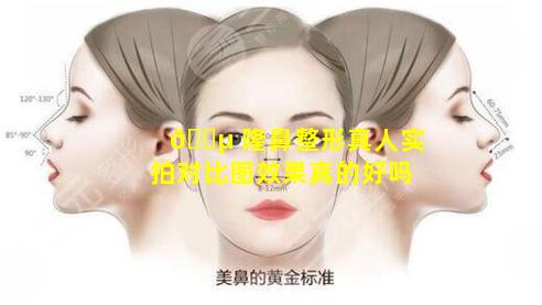 🌵 隆鼻整形真人实拍对比图效果真的好吗